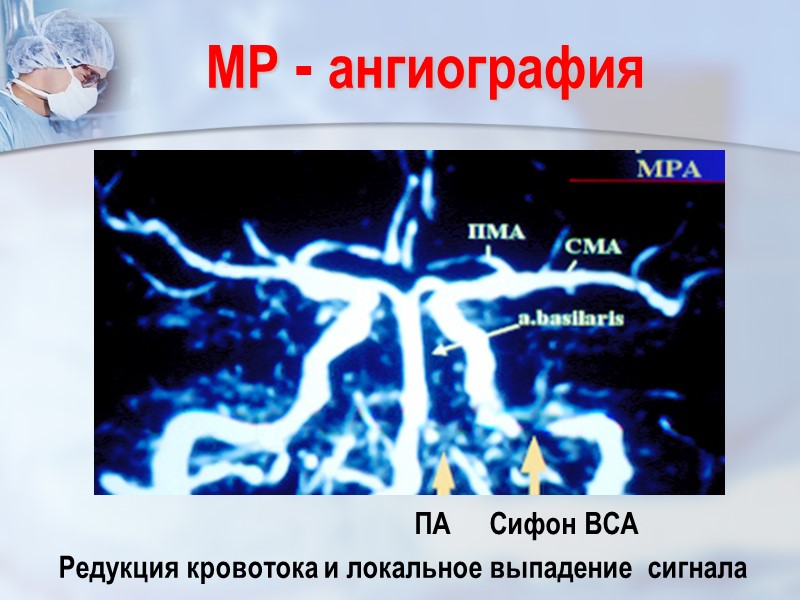 Сифон ВСА МР - ангиография ПА Редукция кровотока и локальное выпадение  сигнала